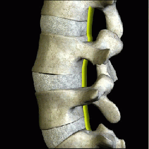 Degenerative Disc Disease (DDD)