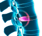 Herniated Disc Alternative Treatment