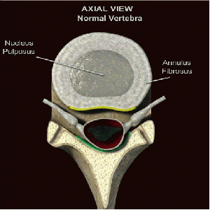 Herniated Disc, looking at it from the top down