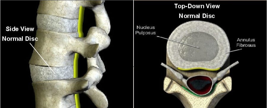 Anatomy of a healthy spinal disc - what is the difference between a bulging disc, herniated disc, ruptured disc and degenerative disc disease