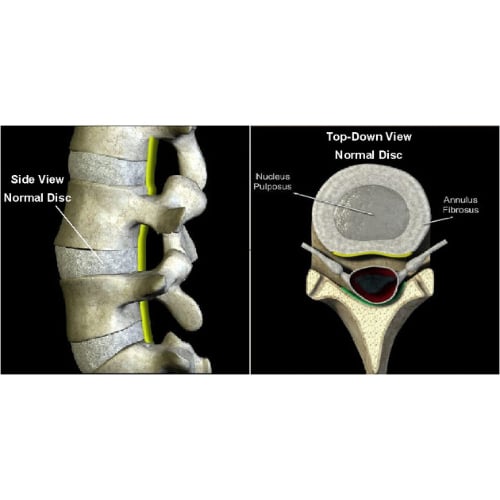 Spinal Disc Anatomy - the Annulus Fibrosus and the Nucleus Pulposus