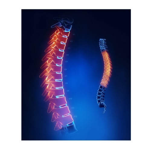 Thoracic Disc Symptoms
